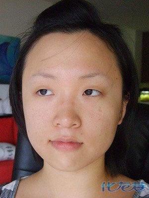 水痘痘疤