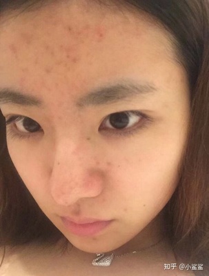 吃辣脸上长痘痘怎么办