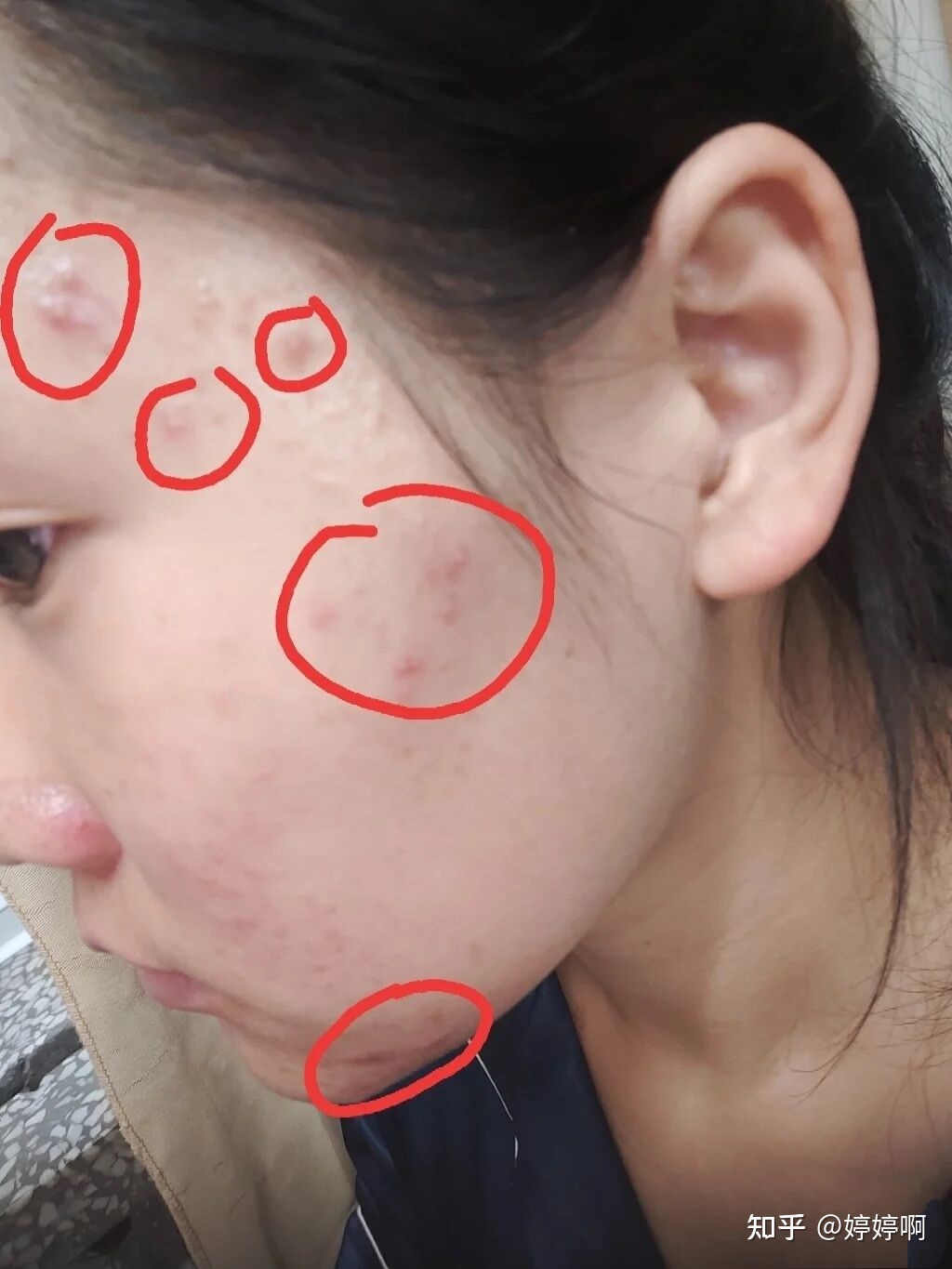 长痘痘长不出来怎么办