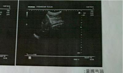 怀孕四个月可以引产吗