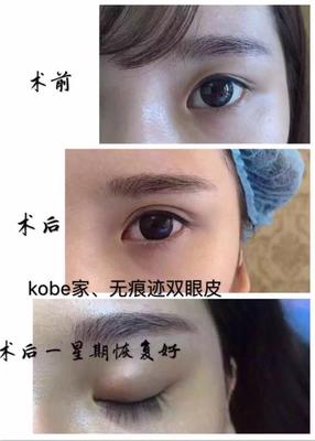 埋线双眼皮多久恢复正常