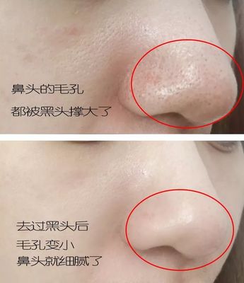 怎么可以让毛孔变小