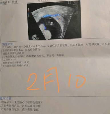 孕吐越厉害胎儿越稳定