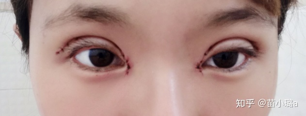 割完双眼皮想再开眼角