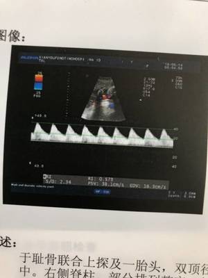 怀孕26周耻骨疼正常吗