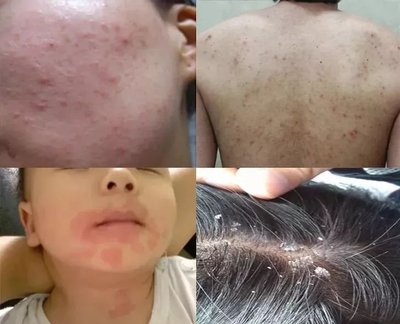 男人背上长痘痘用什么洗