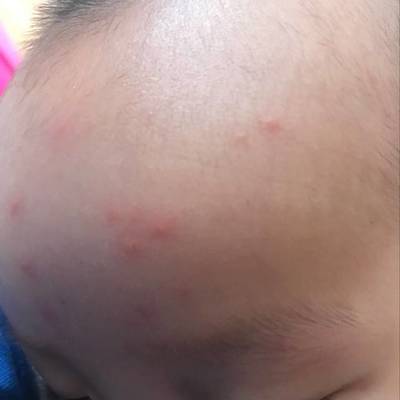 宝宝身上起红点