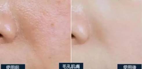 素颜怎么遮痘痘