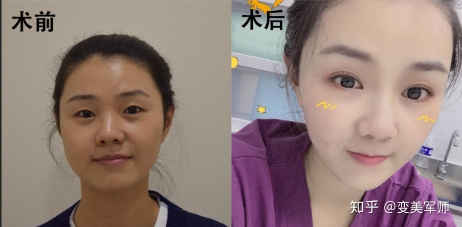 单眼皮埋线疼吗