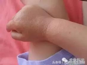 丘疹是怎么回事