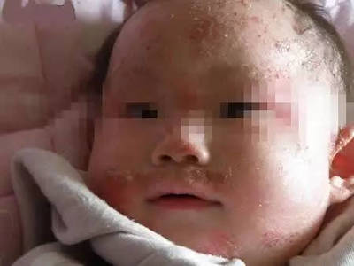 新生儿起了湿疹怎么办