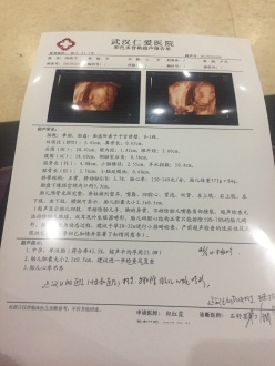 胎儿心律不齐后来好了