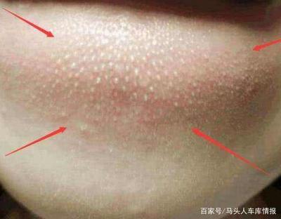 脸上毛孔中的白色东西