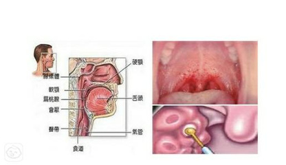 喉咙感觉有臭味是怎么回事