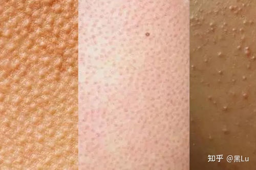 为什麽会起痘痘