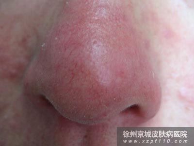 酒糟鼻子怎么治疗效果好