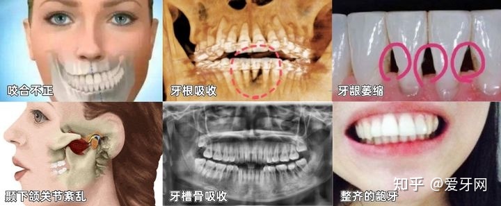 牙齿矫正失败后果