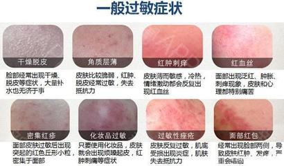 过敏用什么护肤品