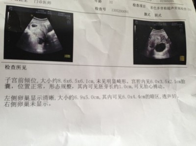 怀孕卵巢囊肿怎么办