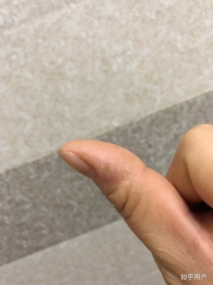 手指上起皮是怎么回事