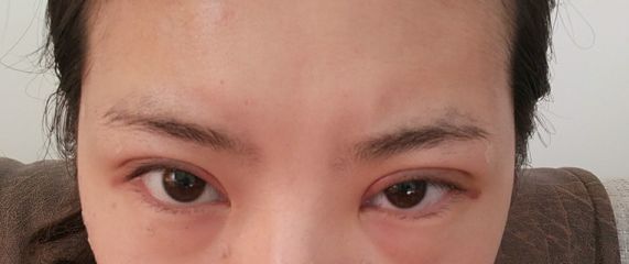 右眼皮肿是怎么回事