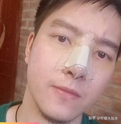 男生隆鼻要多少钱