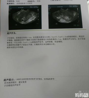 怀孕四十天彩超图片