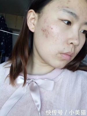 女孩脸上总是长痘痘怎么办
