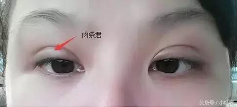 割完双眼皮肉条没知觉