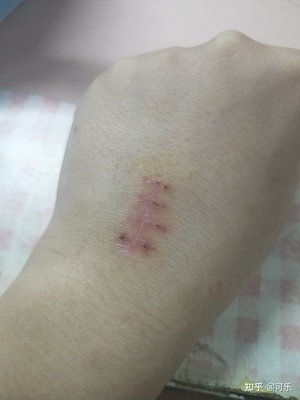 手背疤痕怎么去除