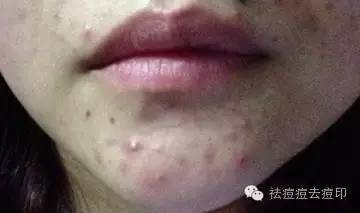 下巴经常长痘痘用什么面膜