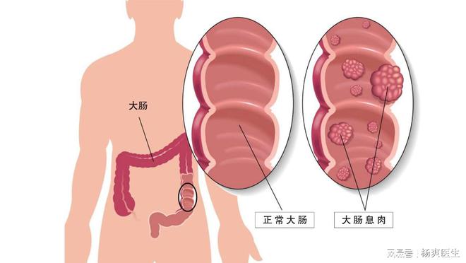 结肠息肉怎么治疗