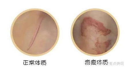 怎么判断自己是疤痕体质