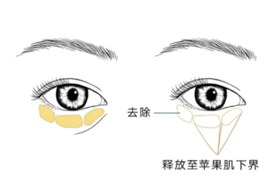眼部脂肪填充