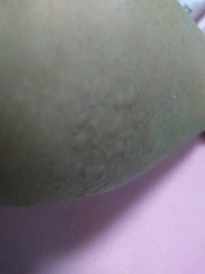 身上起风泡是怎么回事