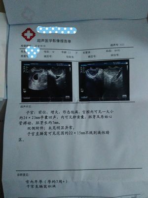 怀孕七周可以做人流吗