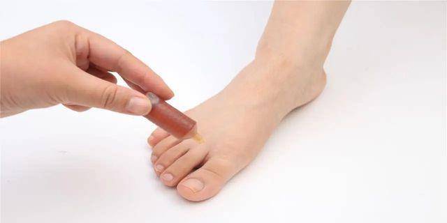 脚底湿疹怎么治疗