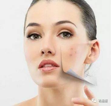 痘印用什么可以消除