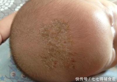 新生儿乳痂图片