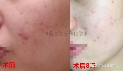 去美容院针清痘痘好吗