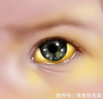 黄疸值多少眼球发黄