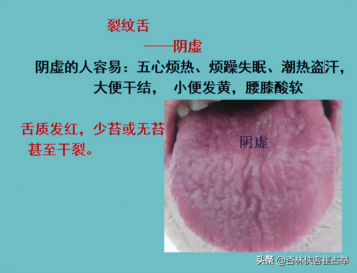舌尖裂纹是怎么回事