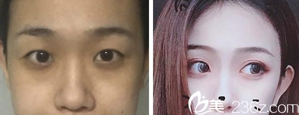 哪做双眼皮好