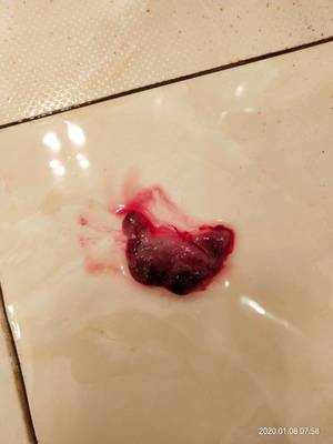 月经期间大块血块是怎么回事