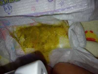 宝宝大便有酸臭味是怎么回事