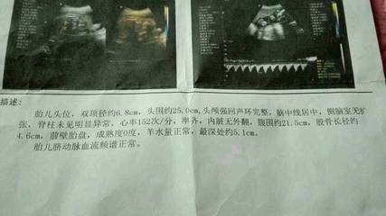 胎儿头偏大是什么原因