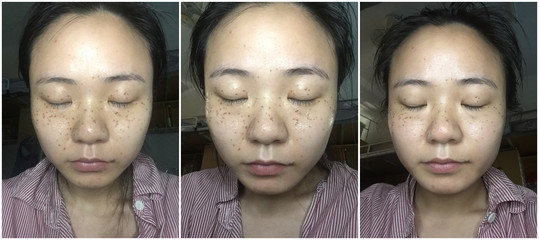 激光祛斑后反黑怎么办