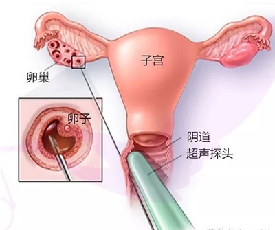 取她人卵多少钱