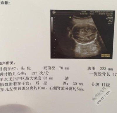 胎儿肾盂扩张是男孩吗