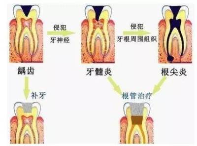 补牙后牙疼吃什么药